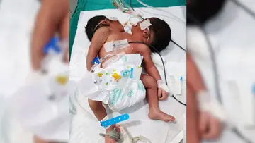 Baby born with two heads in Odisha